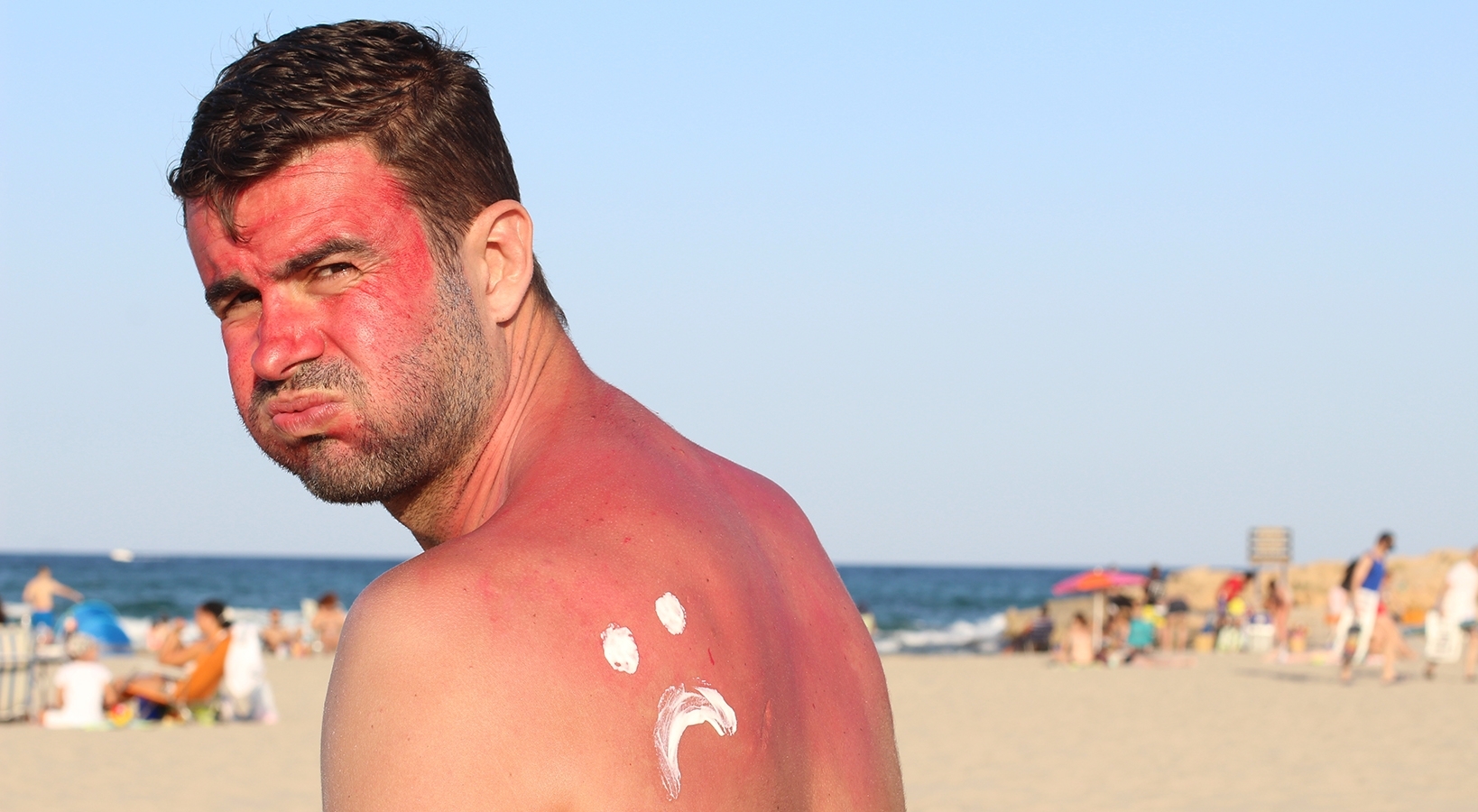 Mann mit Sonnenbrand sitzt am Strand.